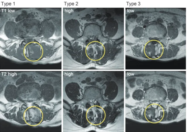 Table 1 shows demographic characteristics of the patients  before surgery. Fig. 1 shows a representative MRI for each  group