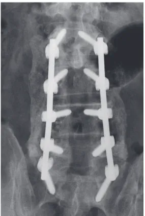 Table 2. Bone graft and extender utilization Bone graft and extenders  