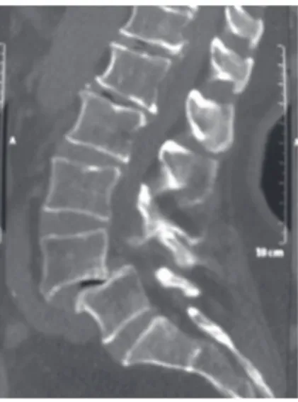 Fig. 2. Lateral (sagittal) lumbar vertebral  computed tomography scan reveals the  lysthetic segment at L4–L5 level.