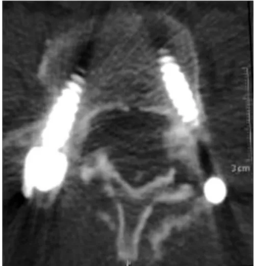 Fig. 6. The laminae 3 months after replacement viewed in  an axial lumbar vertebral computed tomography scan.