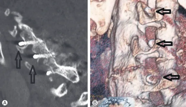 Fig. 3. Postoperative (A) lateral computed tomography (CT) scans and (B) three -dimensional CT reconstruction showing pene- pene-tration of the lateral mass screw into the exiting nerve root foramen (arrows)