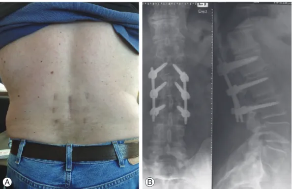 Fig. 1. Postoperative outcome. (A) Incision profile. (B) Standing X-rays at 3 months postoperative.
