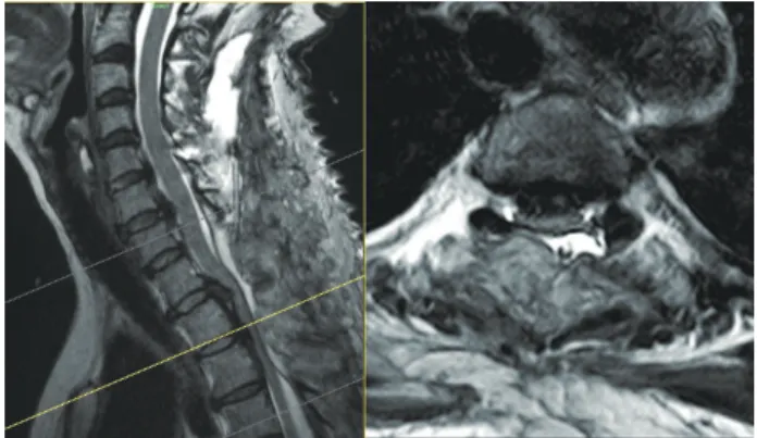 Fig. 2. Intraoperative photography: posterior trans -dural duro- duro-plasty technique