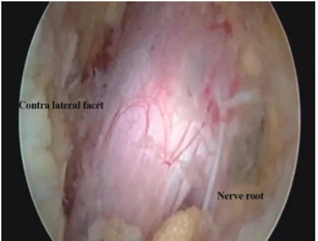 Fig. 6. (A) Preoperative magnetic resonance imaging (MRI) of the  patient show dural sac compression at L3–4 level