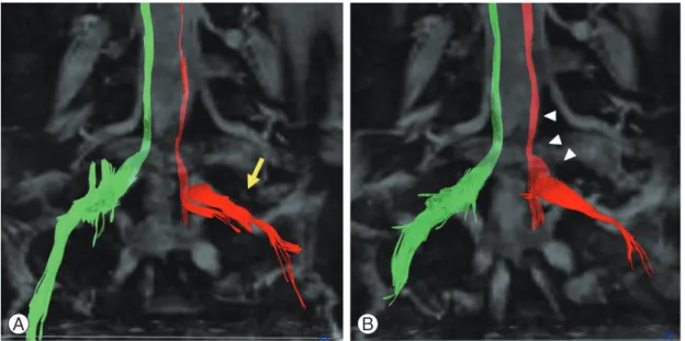 Fig. 6 shows diffusion tensor tractography of bilateral L5  roots. On the entrapment side of the left L5 root, nerve  tracts were disrupted (Fig
