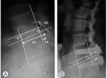 Fig. 1. Radiographic parameters measured on lateral view  of radiographs of lumbar spine