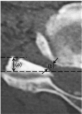 Fig. 2. The position of the superior articular process was  measured by the method of Sunago et al