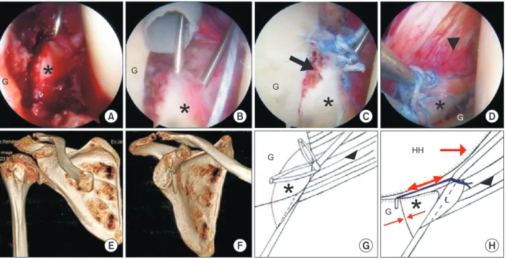 Fig. 2. Arthroscopic findings of the right shoulder from the posterior portal. (A) The fracture fragment of the anterior glenoid rim is displaced medially