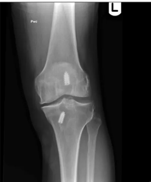 Fig. 1. Knee radiograph at presentation demonstrating cyst formation  around the tibial interference screw