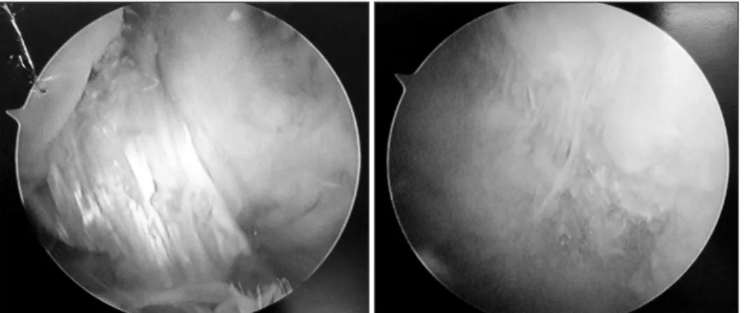 Fig. 3. Arthroscopic images obtained one  year after anterior cruciate ligament (ACL)  reconstruction showing the ACL graft fully  incorporated and intact, and extensive  car-tilage loss over the trochlear region.