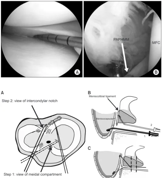 Fig. 1. (A) Confirming the peripheral at- at-tachment lesion of the posterior horn of  the medial meniscus using a probe via the  view of medial compartment