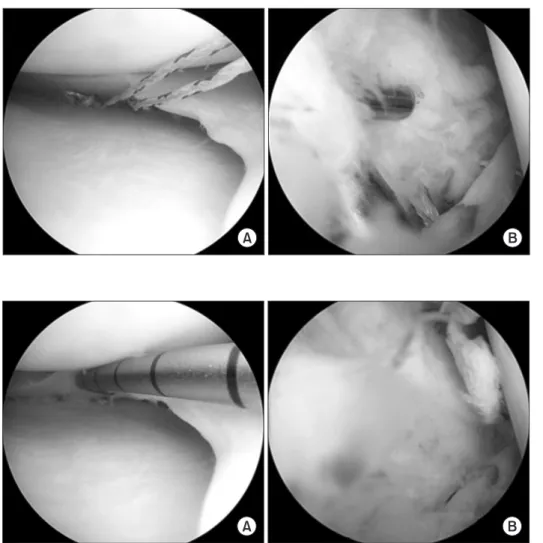 Fig. 3. (A) The meniscus was fixed by two  FasT-Fix devices under inferior surface. 