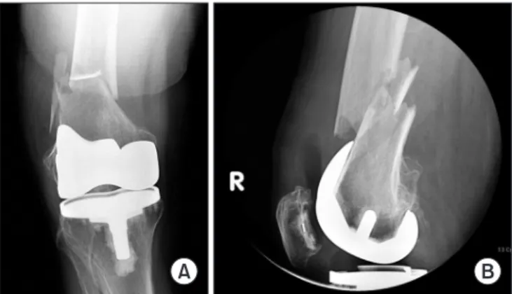 Fig. 2. (A) Lateral radiograph showing a notching of the anterior femoral  cortex after total knee arthroplasty