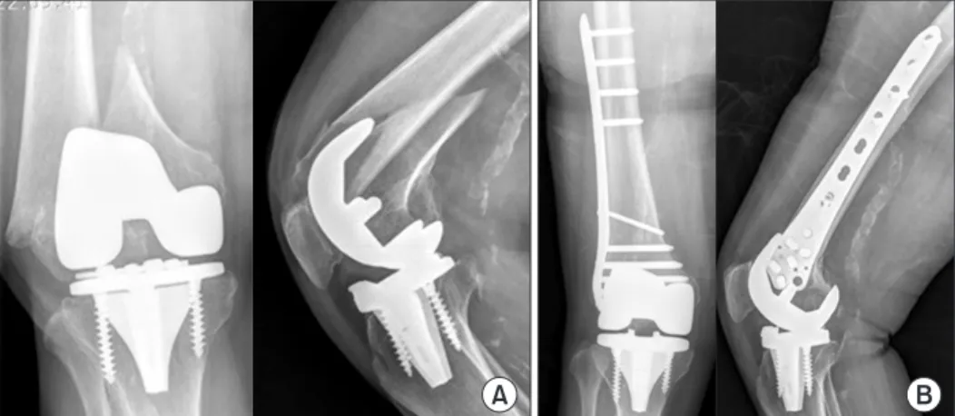 Fig. 7. (A) Anteroposterior and lateral radio- radio-graphs of a displaced supracondylar femoral  fracture following total knee arthroplasty