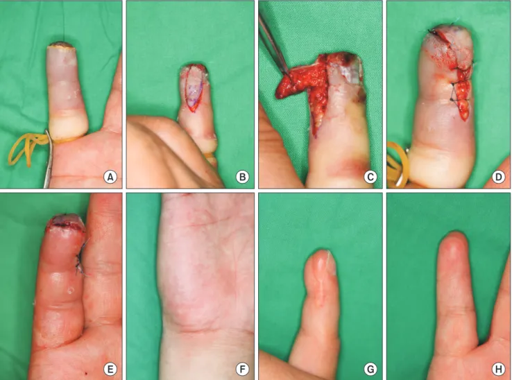 Fig. 1. A patient with complete fingertip amputation of the right little finger. (A) Preoperative view of the defect