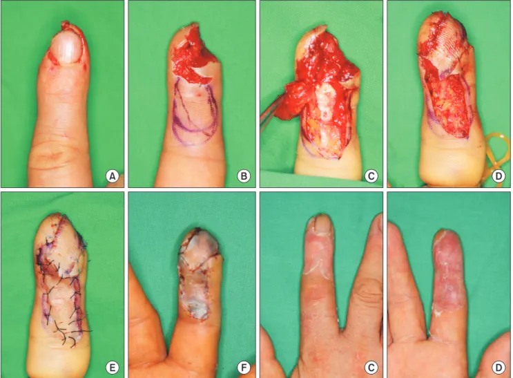 Fig. 2. A patient with a pulp defect of the right index fingertip. (A) Preoperative view of the defect