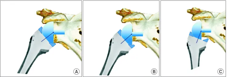 Fig. 4. Due to the surgical method of inferiorly moving the glenoid component, and to the use of the inferiorly protruded implant, scapular notching develops  more medially to the inferior of the glenoid component than as described in Sirveaux’ classificat
