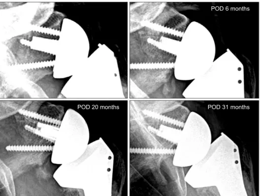 Fig. 5. The case is scapular notching if the  glenoid bone loss developed on the rotational  path of the glenoid component