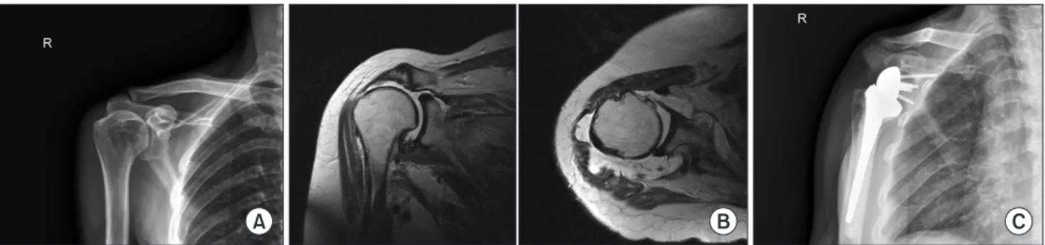 Fig. 2. (A) A preoperative X-ray of a 66-year-old patient with pseudoparalysis shows no osteoarthritic change