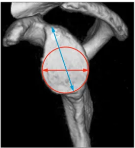 Fig. 3. A computed tomography image of the glenoid was taken in the en  face view. The bare spot was used as the center of the hypothetical circle with  which the glenoid size was measured.