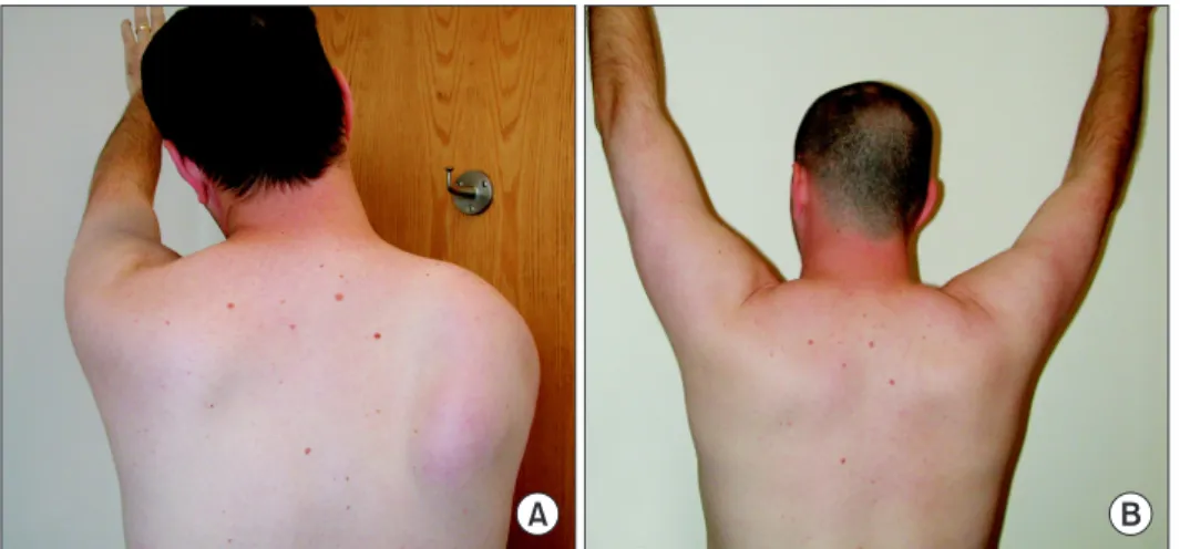 Fig. 1. (A) Scapular winging in patient with  serratus anterior dysfunction. (B)  Postop-erative image showing scapular stabilization  one year after surgery.