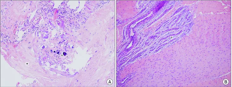 Fig. 5. (A) Calcification pattern at medial epicondylar area: The dark puple circles and hollow asterisk indicate calcification and black asterisk indicates collagen