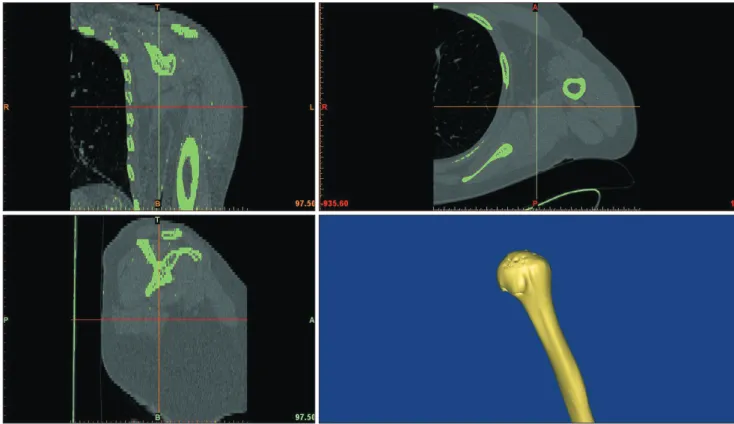 Fig. 2. The greater tuberosity of the 3-dimensional humerus was classified ac-