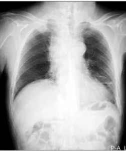 Fig. 4. (A) An axial section of chest computed tomography (CT) shows a pancoast tumor (P) in the right upper lung