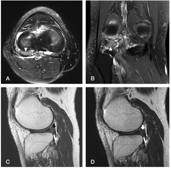 Fig. 1. T2 weighted fat suppression MRI axial (A) and coronal (B) view show an 1.5×1×2cm sized intra-articular mass (white arrow head) located in the posterior compartment between  popli-teus tendon and lateral meniscus