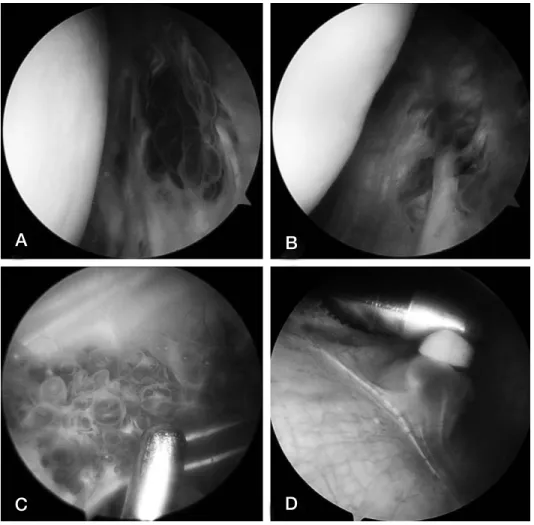 Fig. 3. Arthroscopic view shows no bleeding after com- com-plete resection with partial synovectomy