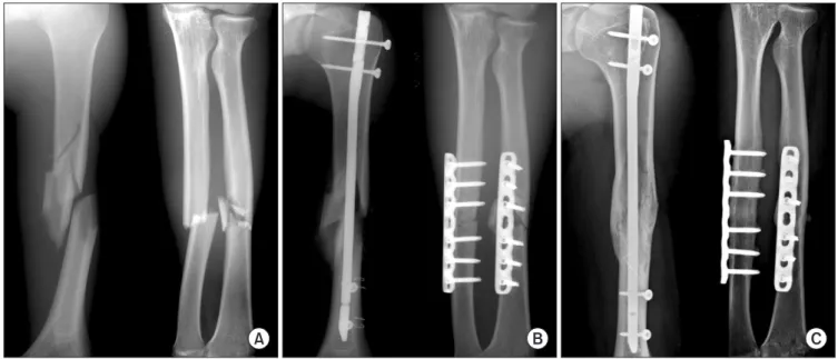 Fig. 1. A 22-year-old man with floating elbow associated with radial nerve injury, multiple fractures, and internal organ injuries