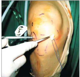 Fig. 2. The torn meniscal fragment is handled with a traction suture (#1- (#1-0 Prolene; Ethicon, Malmo, Sweden).