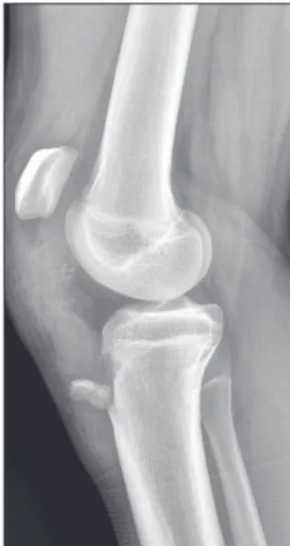 Aosm Avulsion Fracture Of The Tibial Tuberosity With Patellar Ligament 