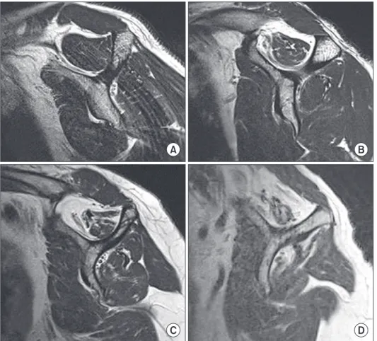 Fig. 1. Classification of fatty degene- degene-ration using Goutallier’s grading systems