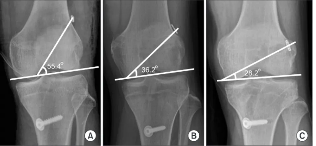 Table 5. Femoral Tunnel Angles