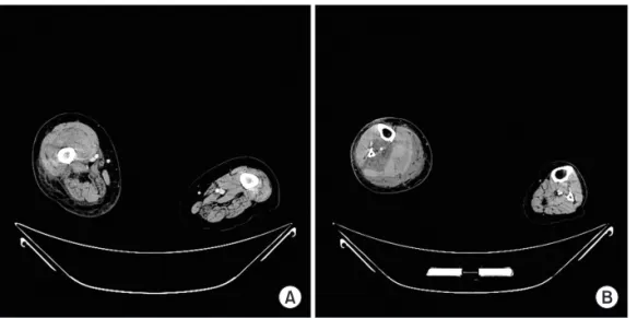 Fig. 2. Preoperative three-dimensional com- com-puter tomographic images show hematomas  in the vastus intermedius and suprapatellar  pouch (A) and in the posterior  compart-ment of the leg (B).