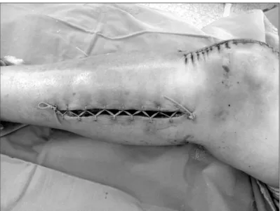 Fig. 5. Hematomas were observed in the vastus intermedius and supra- supra-patellar pouch of the knee joint