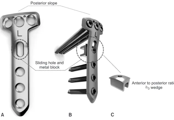 Fig. 1. The new anatomical locking metal  block plate. (A) The upper end of the plate  has a 5-degree posterior slope for better  placement onto the proximal tibia