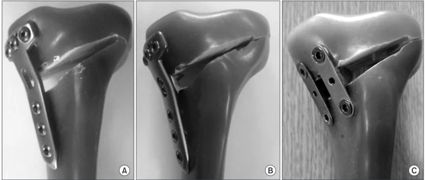 Fig. 2. Three different types of plates are used in sawbones tibia models: (A) Group I, new osteotomy plate without a metal block; (B) Group II, new  oste otomy plate with a 10-mm metal block; and (C) Group III, two short spacer plates.
