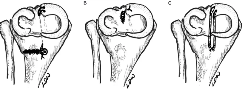 Fig. 4. The illustrations demonstrate different surgical techniqes for MMPRT: (A) pullout suture repair with simple stitches and cortical screw fixa- fixa-tion; (B) suture anchor repair; and (C) double trans-osseous pullout suture repair with simple stitch