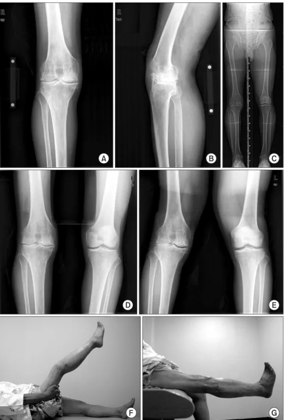 Fig. 1. A 66-year-old male visited our clinic  with right knee pain and limitation of range  of motion (ROM) that had been persistent  for 10 years
