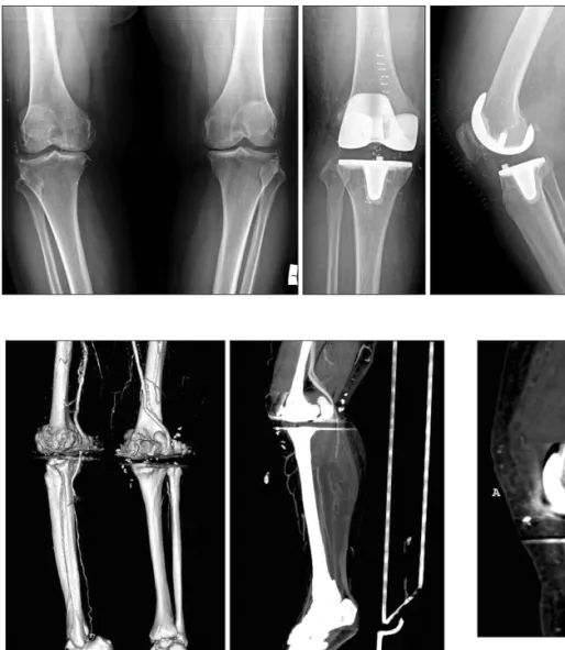Fig. 1. Preoperative anteroposterior ra- ra-diographs of both knees in a 61-year-old  woman showing severe tricompartmental  osteoarthritis of both knees (right&gt;left)