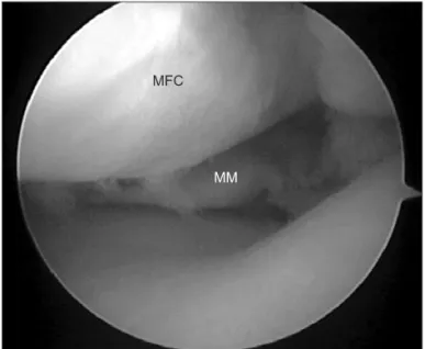 Fig. 2. Under visualization through the anterolateral portal, a suture  hook loaded with a No
