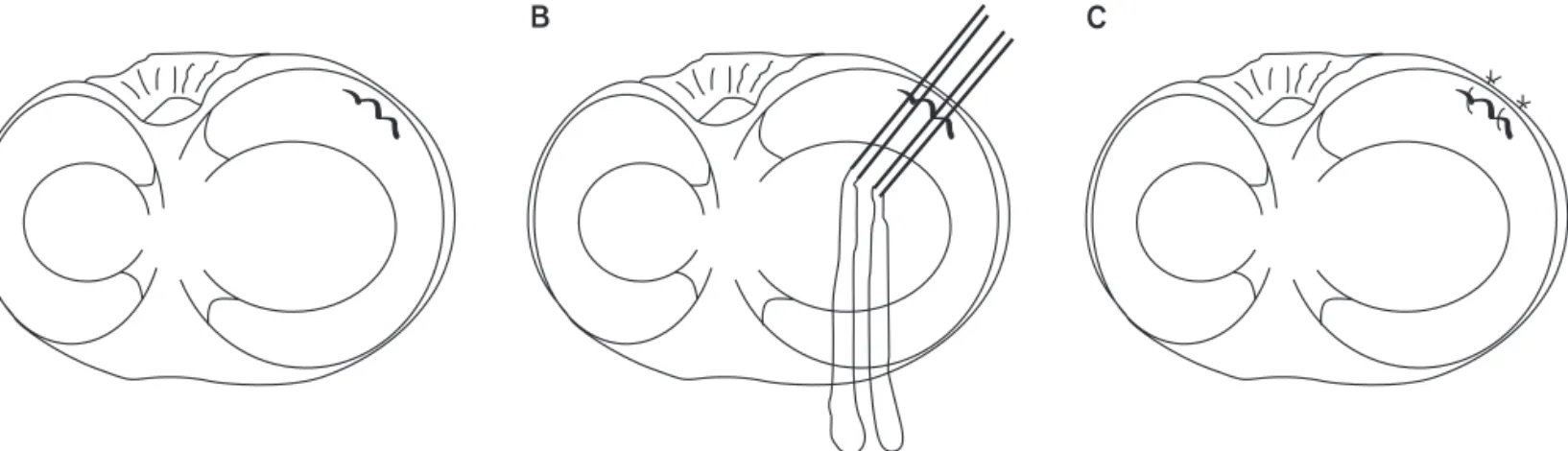 Fig. 1. Inside-out repair technique. (A) A longitudinal tear is identified. (B) Long needles with sutures attached are passed through appropriate can- can-nulas superior and inferior to the tear site
