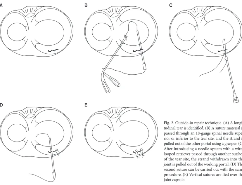 Fig. 2. Outside-in repair technique. (A) A longi- longi-tudinal tear is identified. (B) A suture material is  passed through an 18-gauge spinal needle  supe-rior or infesupe-rior to the tear site, and the strand is  pulled out of the other portal using a g