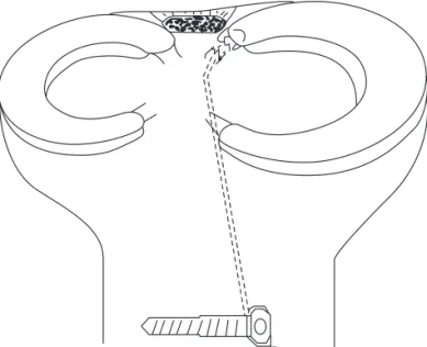 Fig. 4. Illustration of the pull-out repair of the posterior root of the me- me-dial meniscus.
