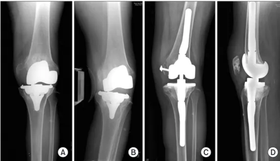 Fig. 1. Varus-valgus stress radiographs of  the knee with instability showing medial  femoral condyle avulsion fracture caused by  severe osteolysis (A) and lift off in the lateral  compartment due to combined lateral laxity  (B)