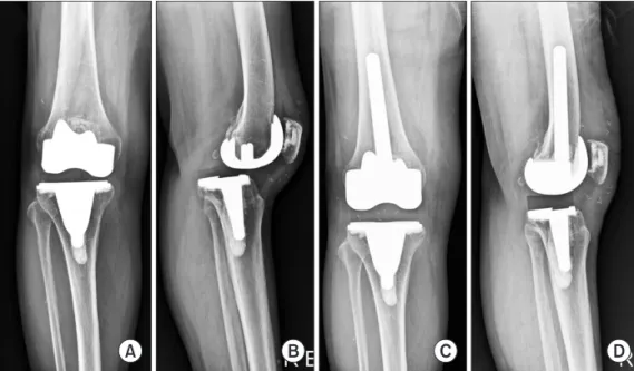 Fig. 2. (A, B) Radiographs of the knee with  instability after total knee arthroplasty using  a cruciate-retaining knee implant