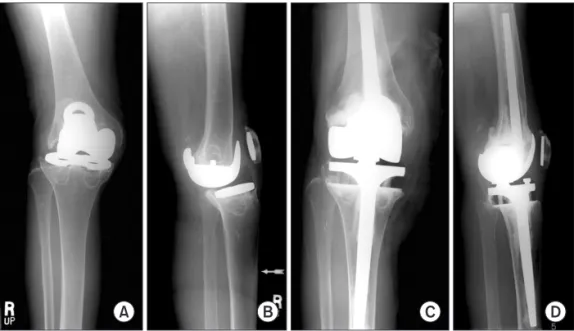 Fig. 3. Radiographs of the knee with severe  bone loss and osteolysis combined with  re-curvatum (A) and global instability (B)