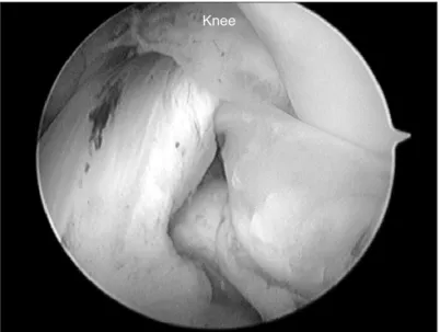 Fig. 2. (A) An 18-gauge spinal needle first  penetrates the capsular portion, crosses  the tear, and then exits the tibial surface of  the inner fragment of the middle segment  of the lateral meniscus in the bone model